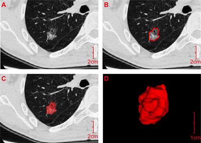 Predictive Efficacy of a Radiomics Random Forest Model for Identifying Pathological Subtypes of Lung Adenocarcinoma Presenting as Ground-Glass Nodules